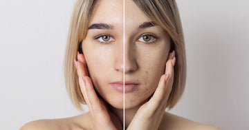 Why Triclear SA Cream is a Game-Changer for Acne and Oily Skin