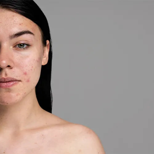 Acne