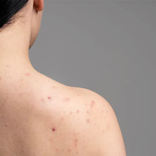 Body Acne