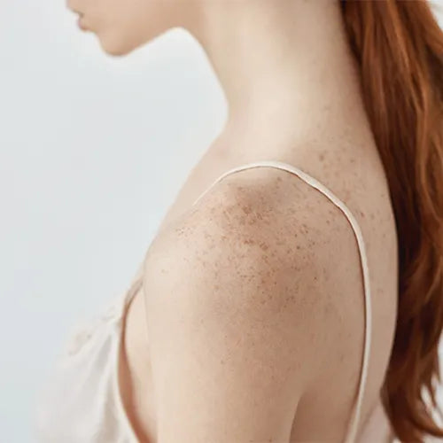 Body Pigmentation