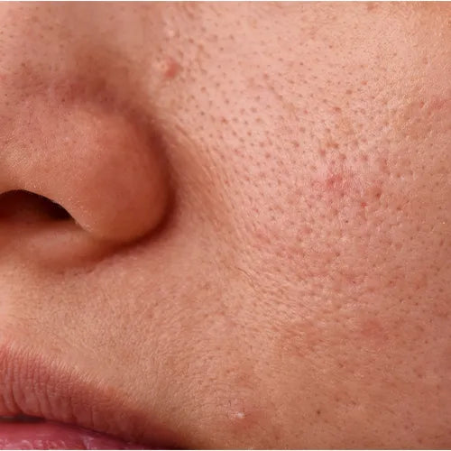 Open Pore