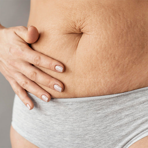 Stretch Marks